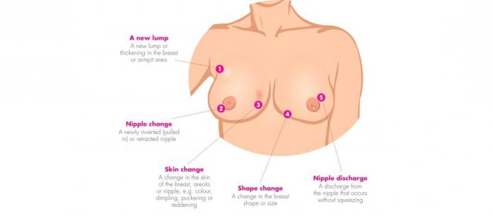 рак молочной железы 2 стадии прогноз злокачественная опухоль 