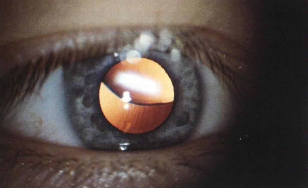 Фото вывиха хрусталика глаза у человека