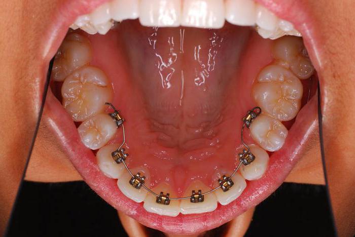отпечатки зубов на языке по бокам причины