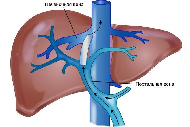 синдром бадда киари диагностика