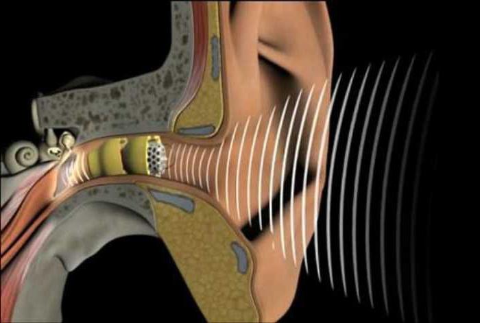 восстановление слуха при нейросенсорной тугоухости