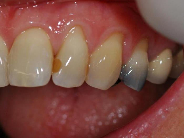 плюсы и минусы металлических пломб для зубов