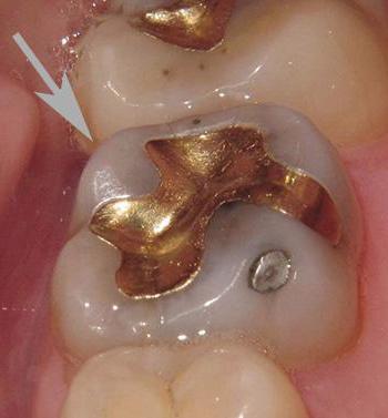 металлические пломбы для зубов