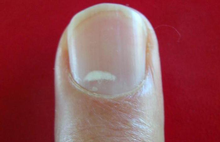 белые пятна на ногтях среднего пальца руки