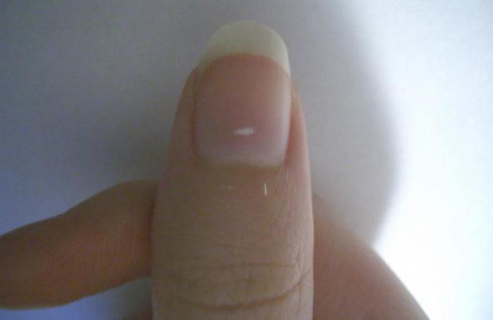 белые пятна на ногтях пальцев рук лечение