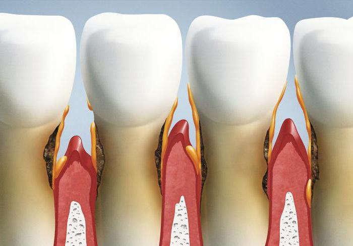 особенности заболеваний пародонта
