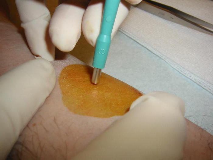 биопсия кожи при псориазе