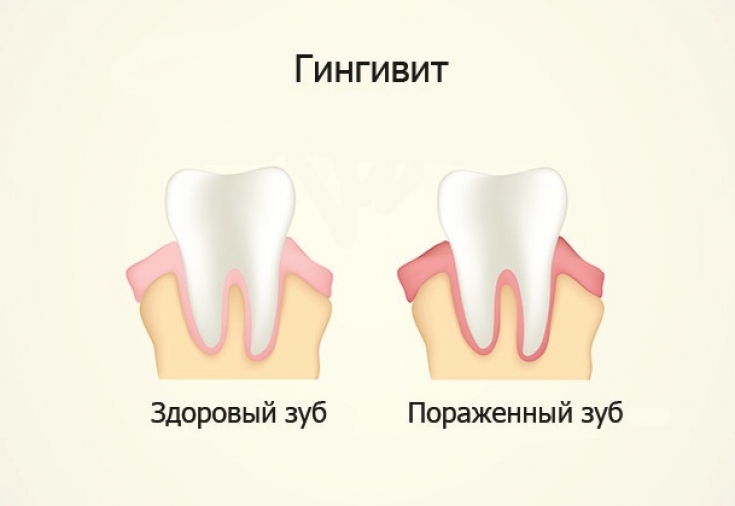 воспаление десны около зуба лечение