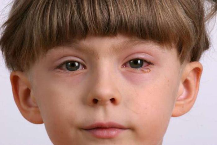 капли для глаз при аллергии на амброзию