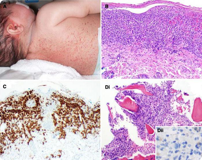 гистиоцитоз Лангерганса у детей фото
