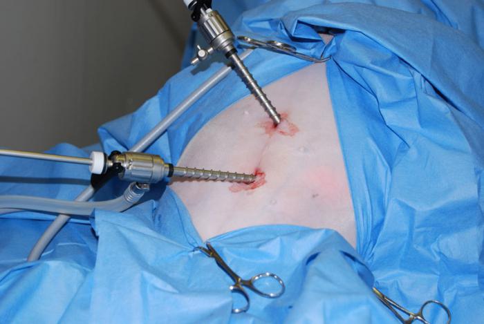  удаление миомы матки лапароскопическим методом 
