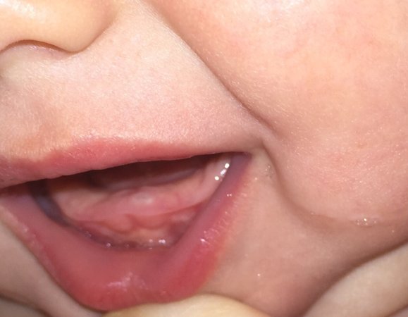 Симптомы прорезывания зубов у детей