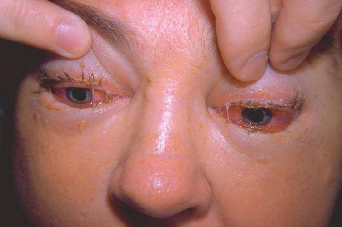 паразиты в глазах человека симптомы