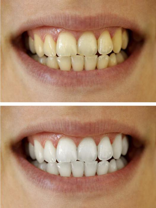 Crest 3D white whitestrips Professional Effects 