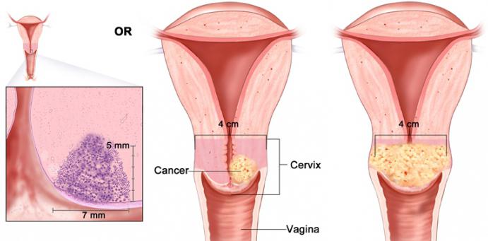 рак шейки матки 2 стадия выживаемость 