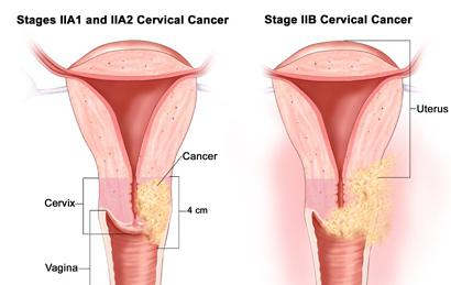 рак шейки матки 2 стадия продолжительность жизни отзывы 