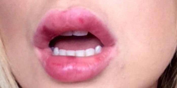 губы после биополимера