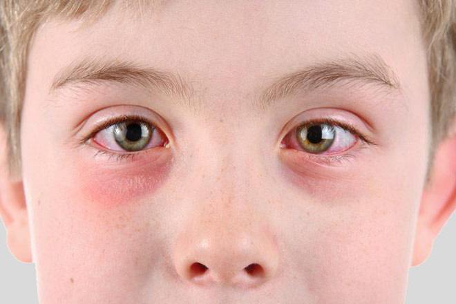 аллергический конъюнктивит симптомы
