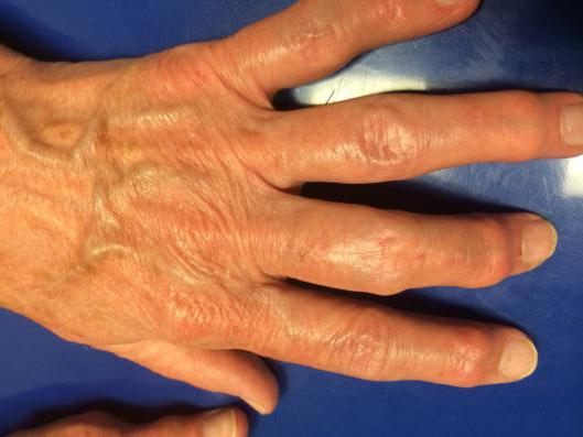 остеоартроз кистей рук симптомы