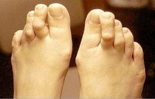кривые пальцы ног