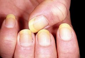грибок ногтей на руках лечение