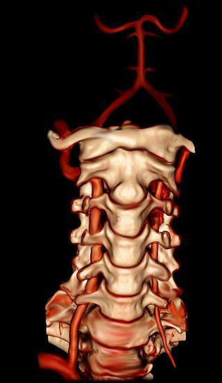 гипоплазия левая позвоночная артерия