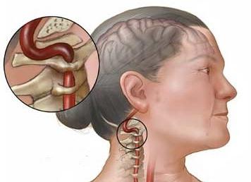 остеохондроз синдром позвоночной артерии