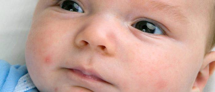 жировики на лице у ребенка причины