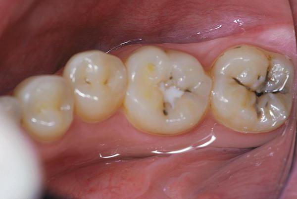 почему болит зуб после пломбирования каналов отзывы