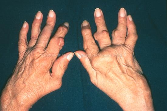 артрит суставов пальцев рук
