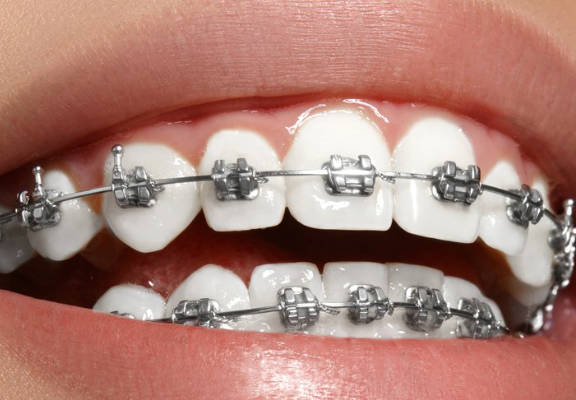 устранение щели между зубами с помощью брекетов