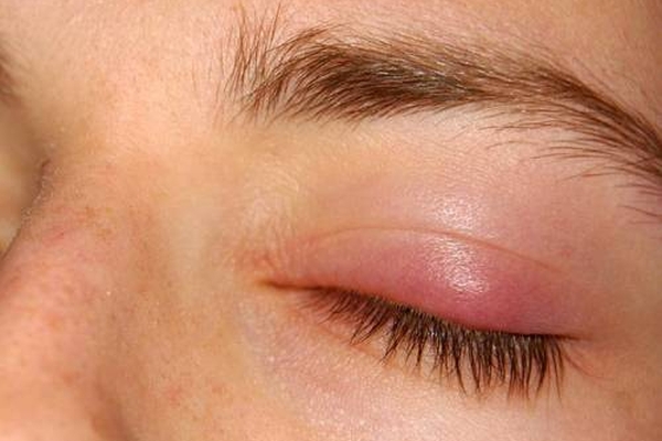 "Блефарогель" от морщин для лица и вокруг глаз: инструкция и отзывы косметологов