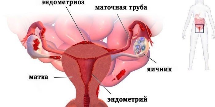 Какими лекарствами лечить эндометриоз