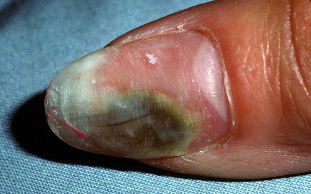 Плесень на ногтях: причины появления и лечение