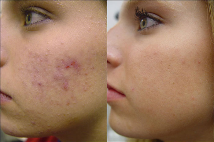 проблемная кожа лица (до и после использования лечебной маски)