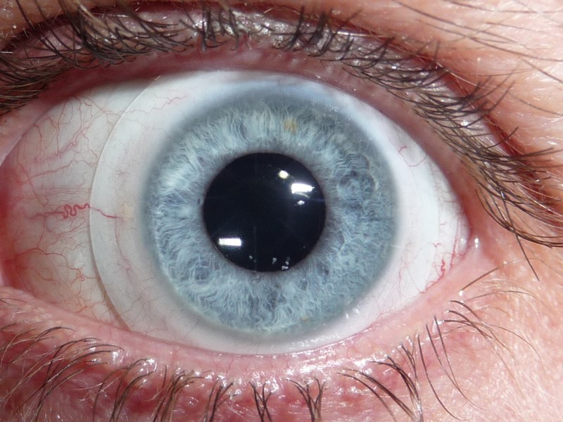 Склеральные линзы на глазу