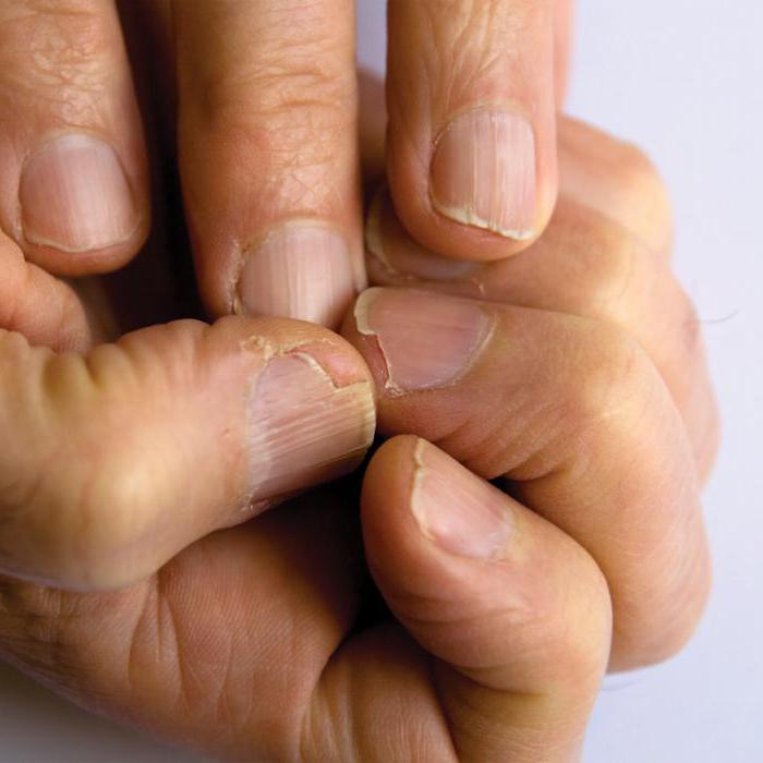 Расслоение ногтей на руках: причины и лечение
