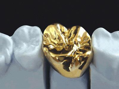 золотые зубы цена
