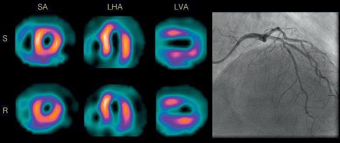 сцинтиграфия миокарда противопоказания