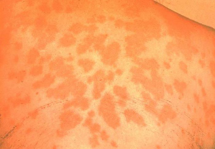 грибковые заболевания кожи симптомы и лечение фото