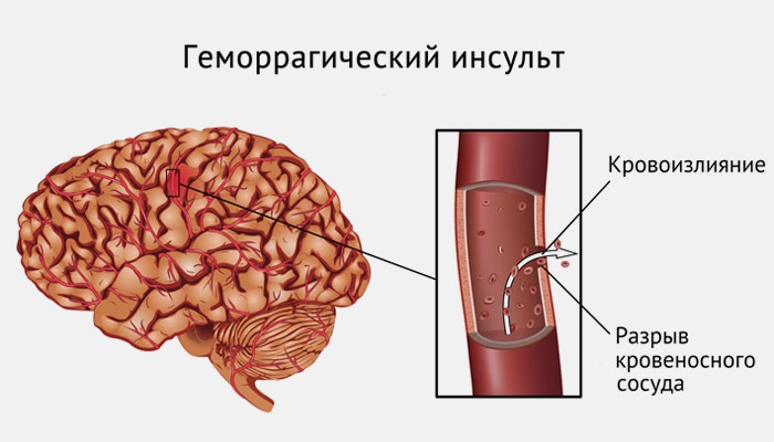 инсульт мкб 10