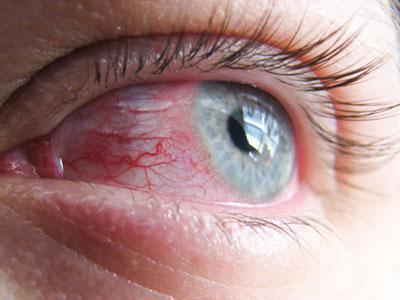 лечить воспаление верхнего века глаза