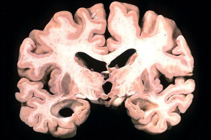 болезнь паркинсона и альцгеймера