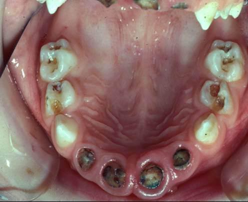 молочные зубы у детей кариес 