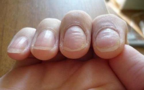 Дистрофия ногтевой пластины: причины, виды, лечение