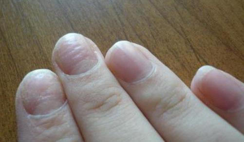 Дистрофия ногтевой пластины: причины, виды, лечение
