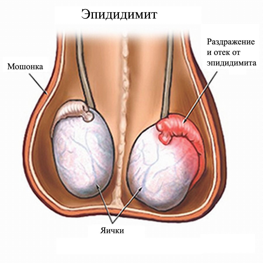 острый эпидидмит