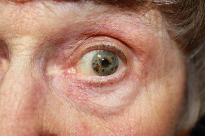 глаукома у пожилых людей, особенности лечения