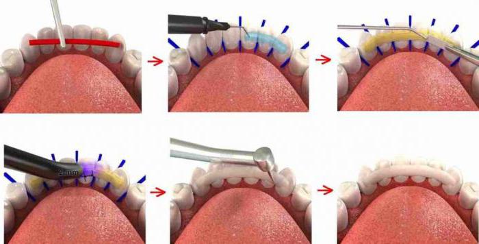 Методы шинирования подвижных зубов при пародонтите