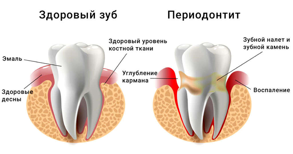 Здоровый зуб Vs больной зуб